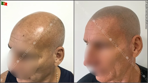 tricopigmentacao-scalpmicropigmentation-microcapilar-restaurar-cabelo-rapado-micropigmentacao-capilar-elan-mello-portugal-lisboa-3-w