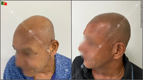 tricopigmentacao-scalpmicropigmentation-microcapilar-restaurar-cabelo-rapado-micropigmentacao-capilar-elan-mello-portugal-lisboa-6-w